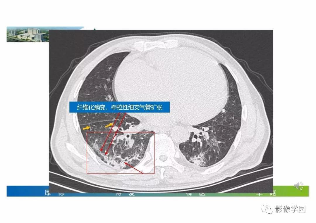 【PPT】输入性新冠肺炎的影像学特点与识别
