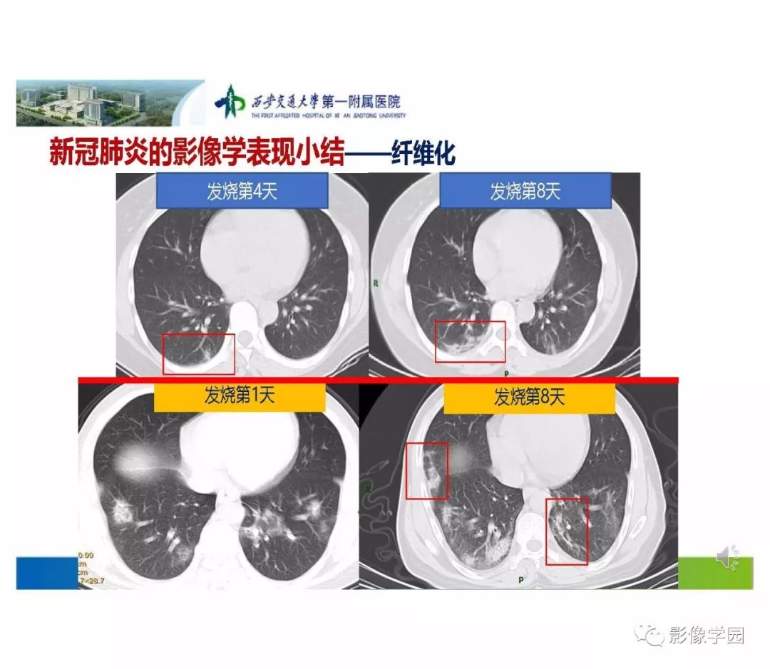 【PPT】输入性新冠肺炎的影像学特点与识别