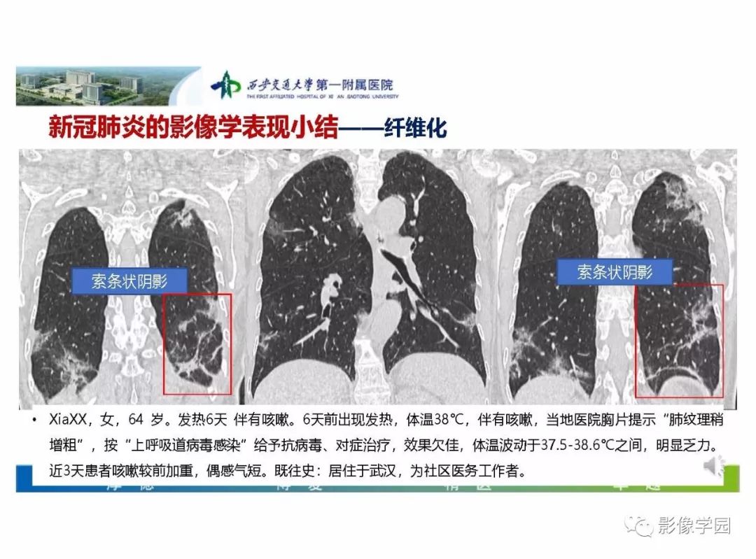 【PPT】输入性新冠肺炎的影像学特点与识别