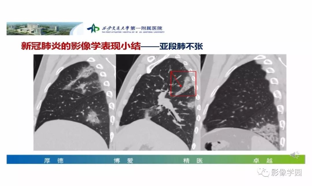【PPT】输入性新冠肺炎的影像学特点与识别