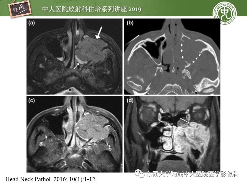 【PPT】鼻腔鼻窦恶性肿瘤影像诊断