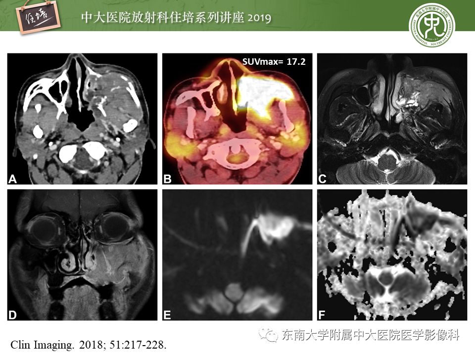 【PPT】鼻腔鼻窦恶性肿瘤影像诊断