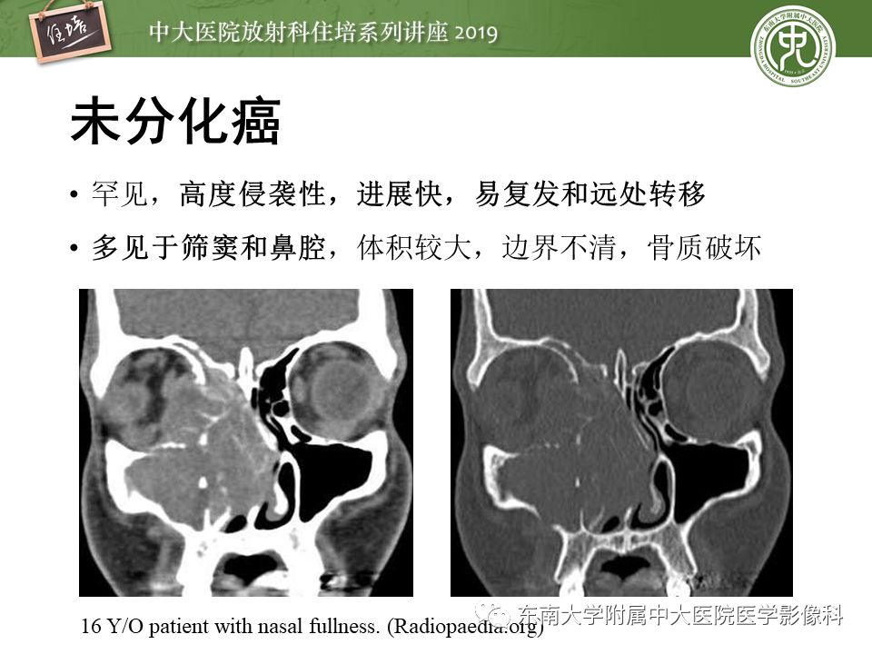【PPT】鼻腔鼻窦恶性肿瘤影像诊断