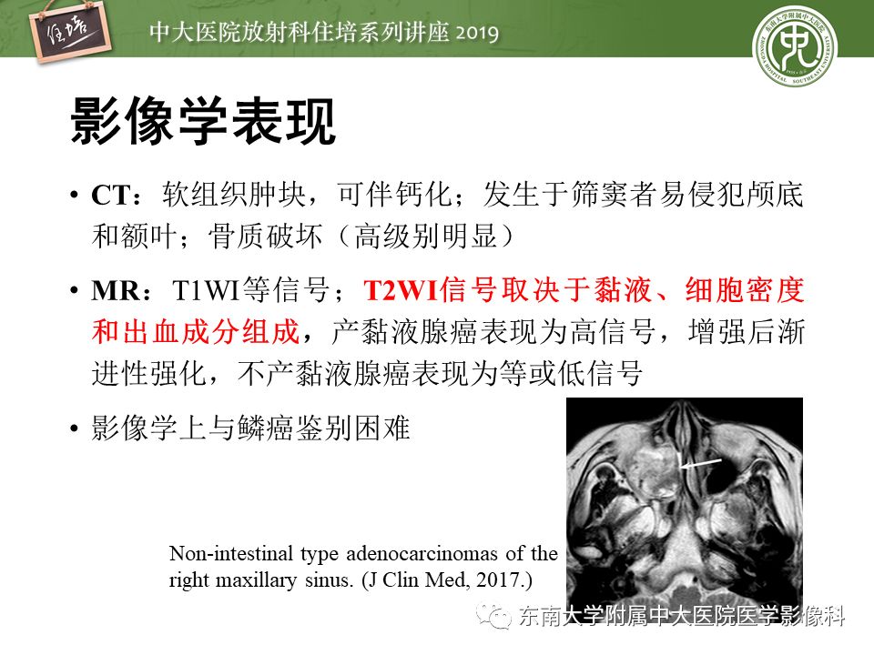 【PPT】鼻腔鼻窦恶性肿瘤影像诊断