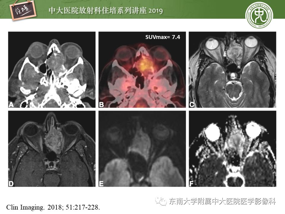 【PPT】鼻腔鼻窦恶性肿瘤影像诊断