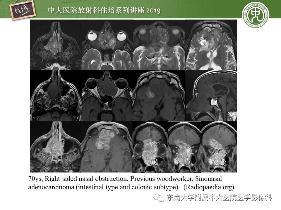 【PPT】鼻腔鼻窦恶性肿瘤影像诊断