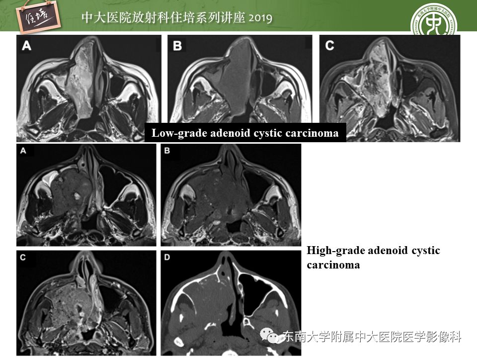 【PPT】鼻腔鼻窦恶性肿瘤影像诊断