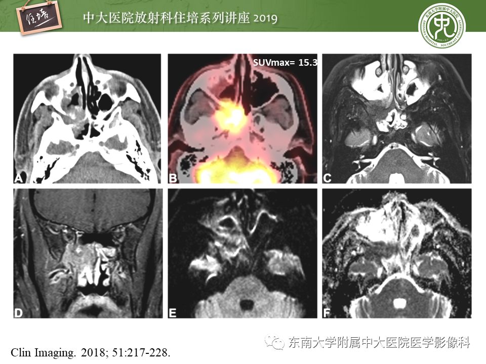 【PPT】鼻腔鼻窦恶性肿瘤影像诊断