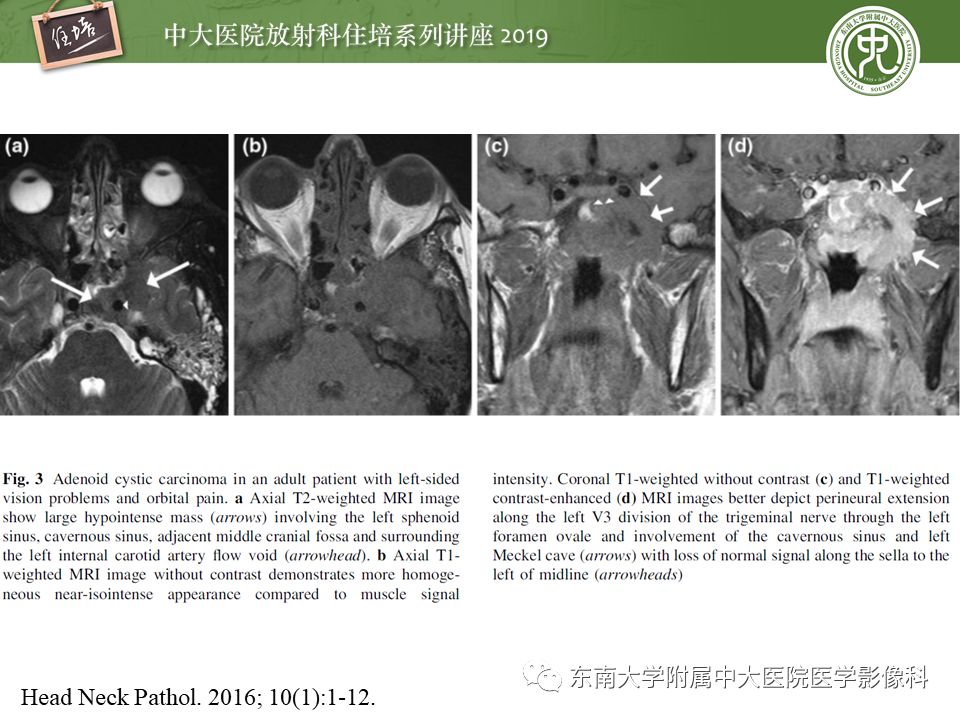 【PPT】鼻腔鼻窦恶性肿瘤影像诊断