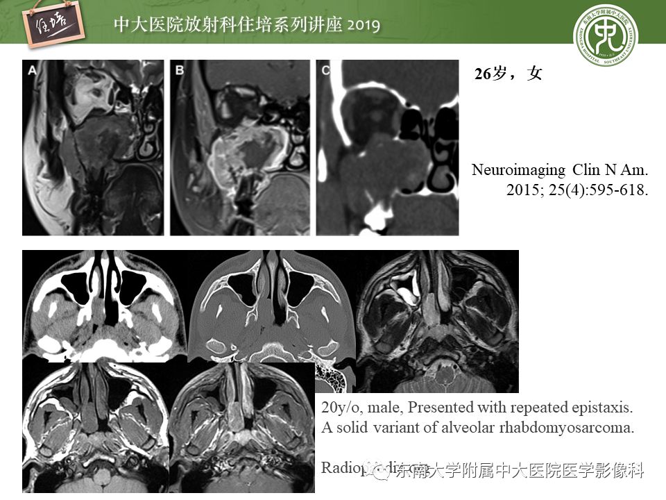 【PPT】鼻腔鼻窦恶性肿瘤影像诊断