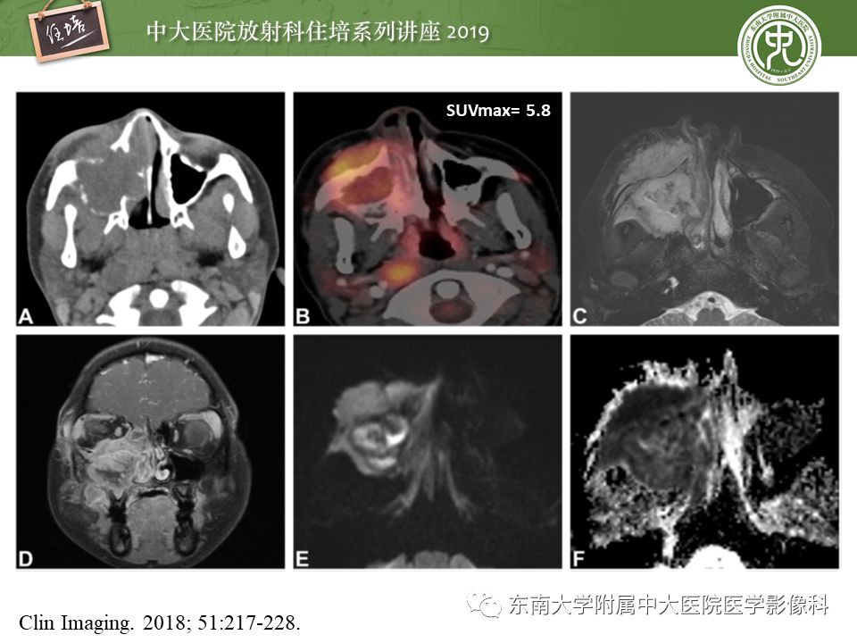 【PPT】鼻腔鼻窦恶性肿瘤影像诊断