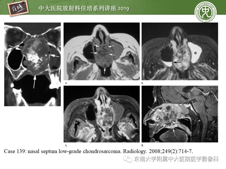 【PPT】鼻腔鼻窦恶性肿瘤影像诊断