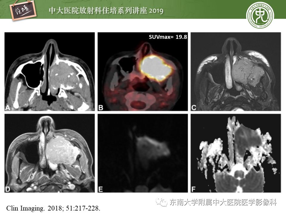 【PPT】鼻腔鼻窦恶性肿瘤影像诊断