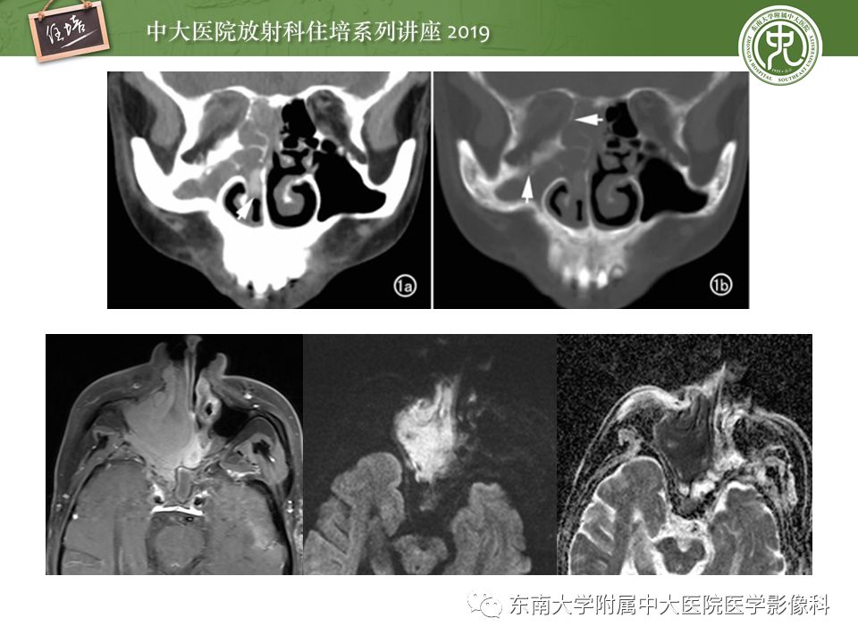 【PPT】鼻腔鼻窦恶性肿瘤影像诊断