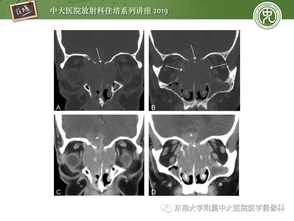 【PPT】鼻腔鼻窦恶性肿瘤影像诊断