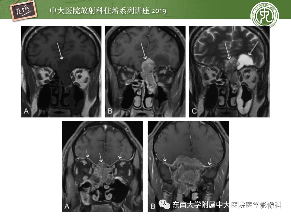 【PPT】鼻腔鼻窦恶性肿瘤影像诊断