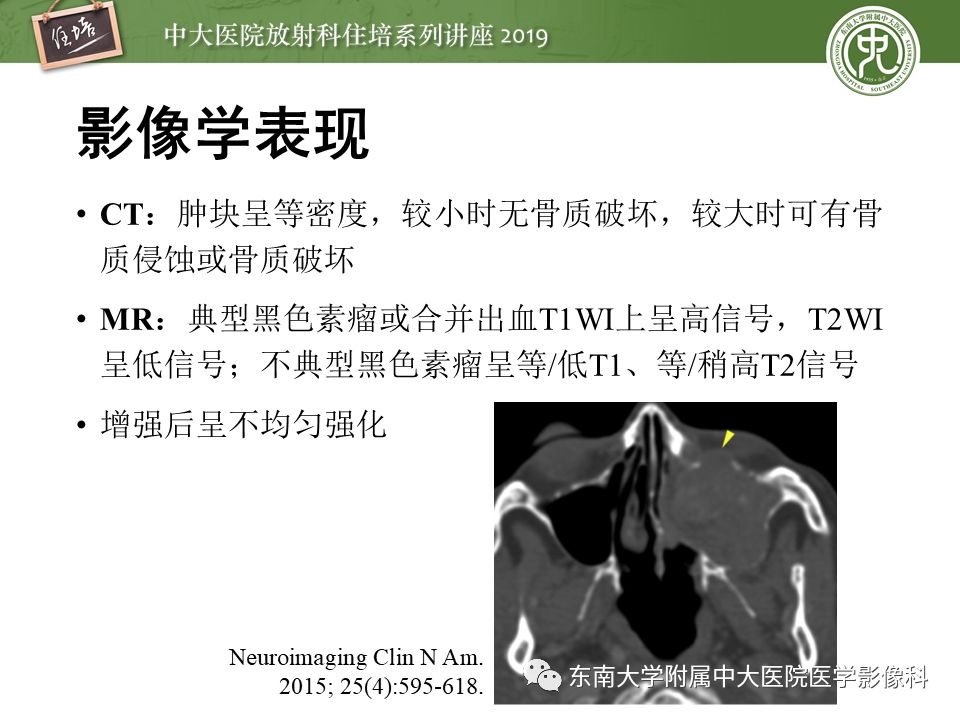 【PPT】鼻腔鼻窦恶性肿瘤影像诊断