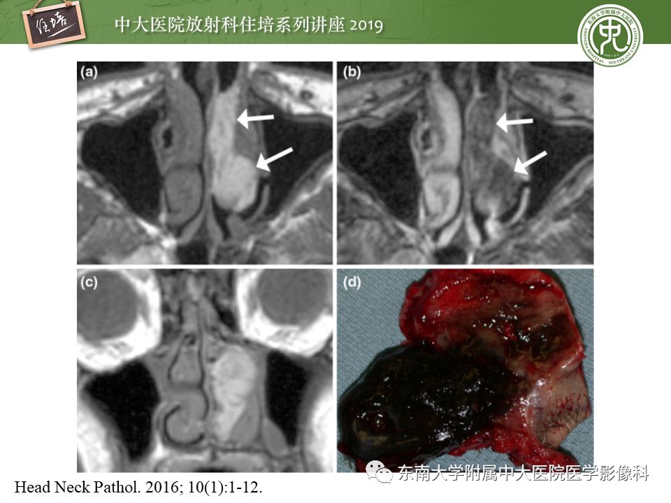 【PPT】鼻腔鼻窦恶性肿瘤影像诊断