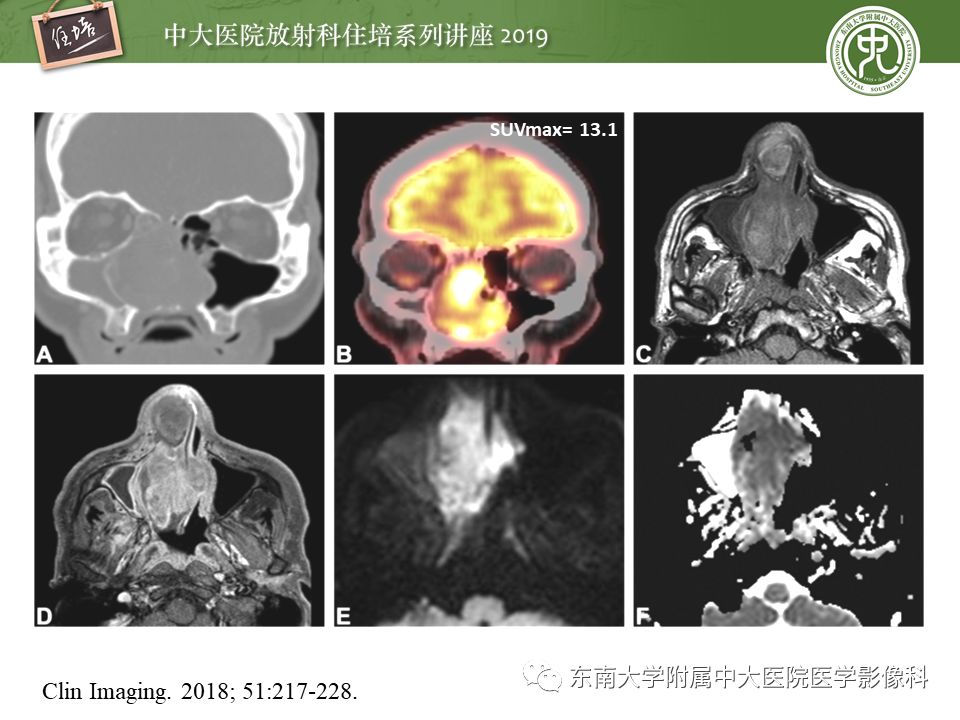 【PPT】鼻腔鼻窦恶性肿瘤影像诊断