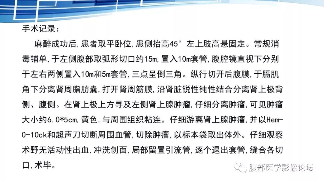 【PPT】腹膜后孤立性纤维瘤的影像
