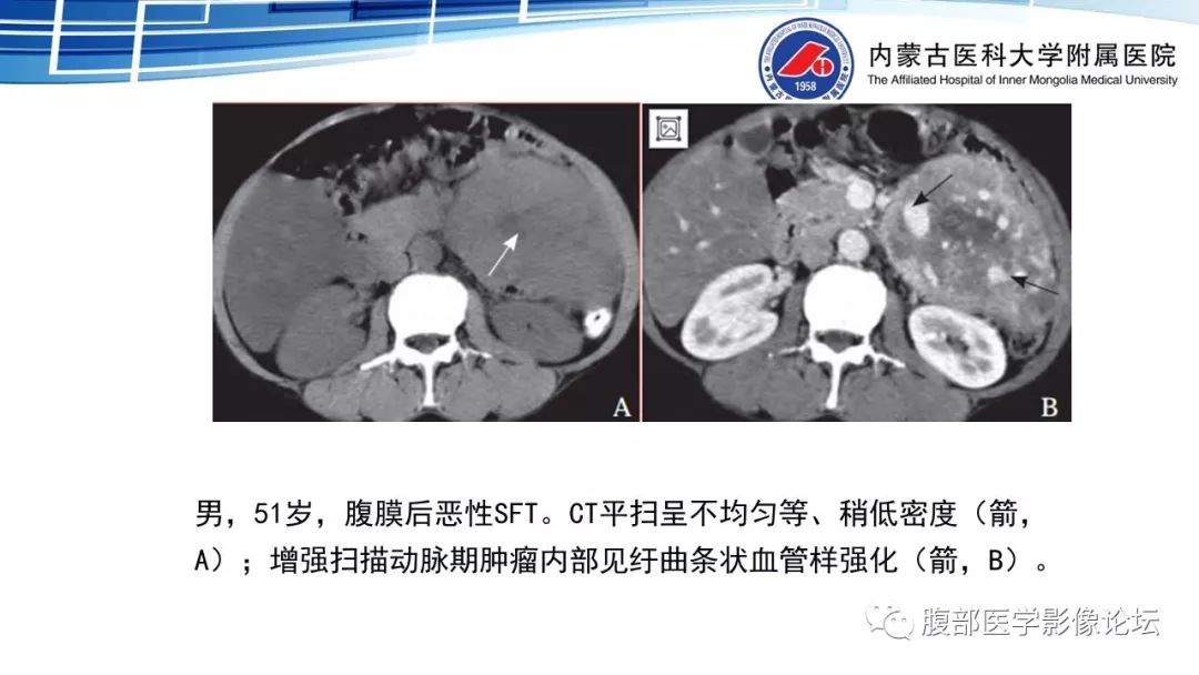 【PPT】腹膜后孤立性纤维瘤的影像
