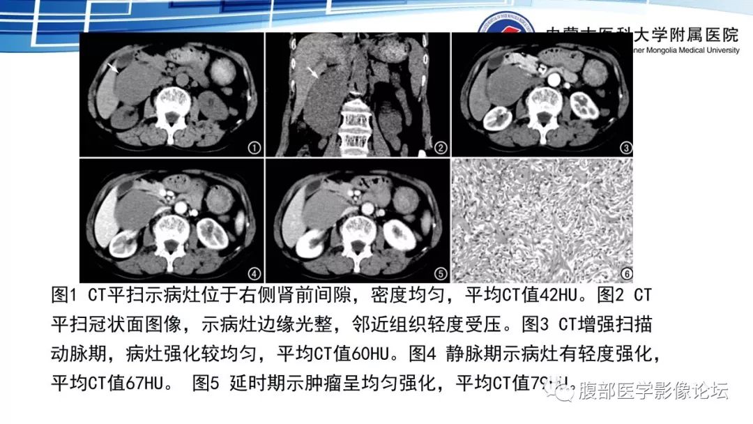 【PPT】腹膜后孤立性纤维瘤的影像
