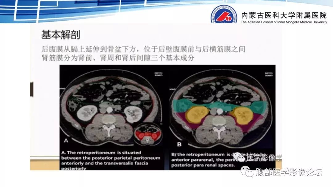 【PPT】腹膜后孤立性纤维瘤的影像