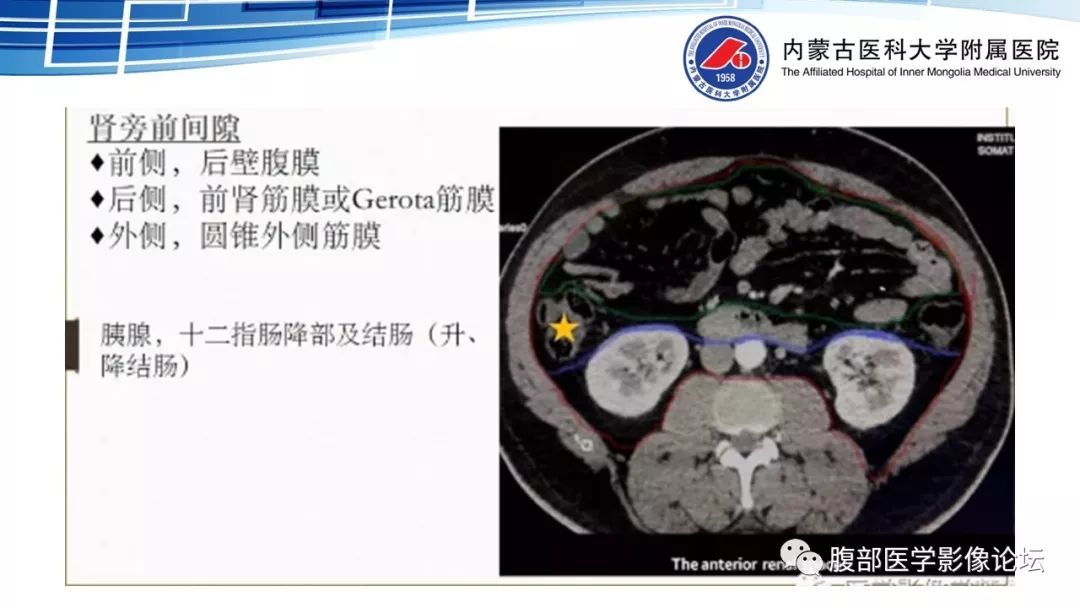 【PPT】腹膜后孤立性纤维瘤的影像