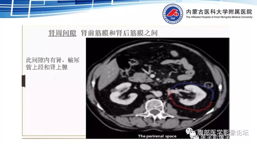 【PPT】腹膜后孤立性纤维瘤的影像