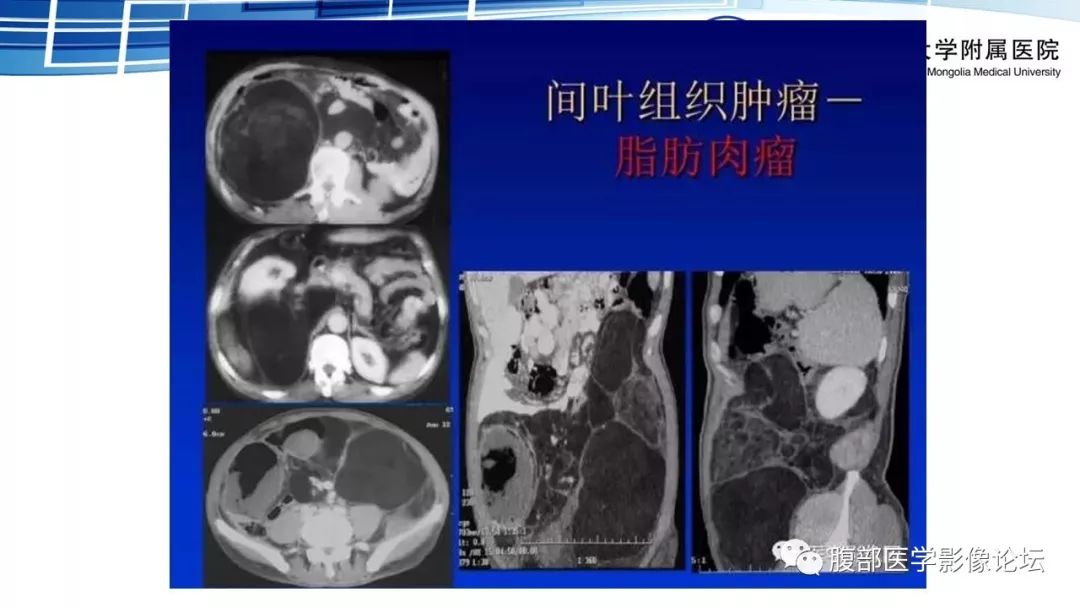 【PPT】腹膜后孤立性纤维瘤的影像