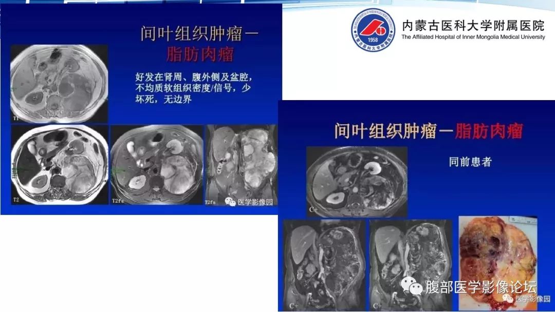 【PPT】腹膜后孤立性纤维瘤的影像