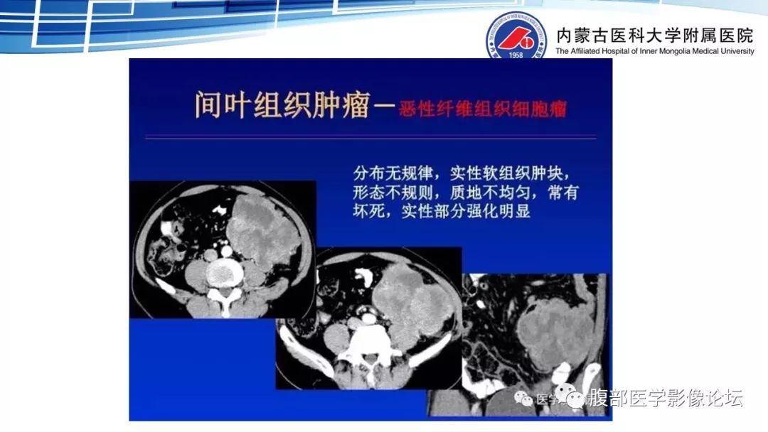 【PPT】腹膜后孤立性纤维瘤的影像