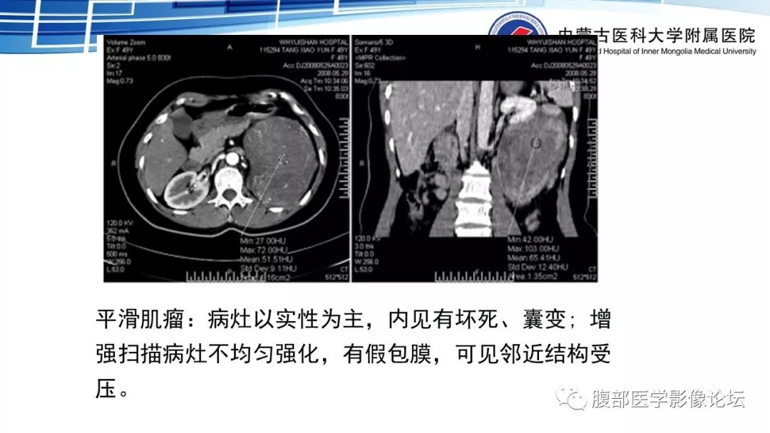 【PPT】腹膜后孤立性纤维瘤的影像