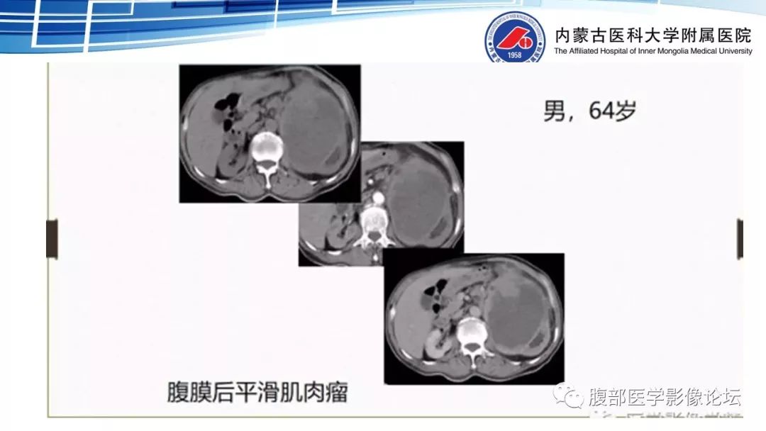 【PPT】腹膜后孤立性纤维瘤的影像