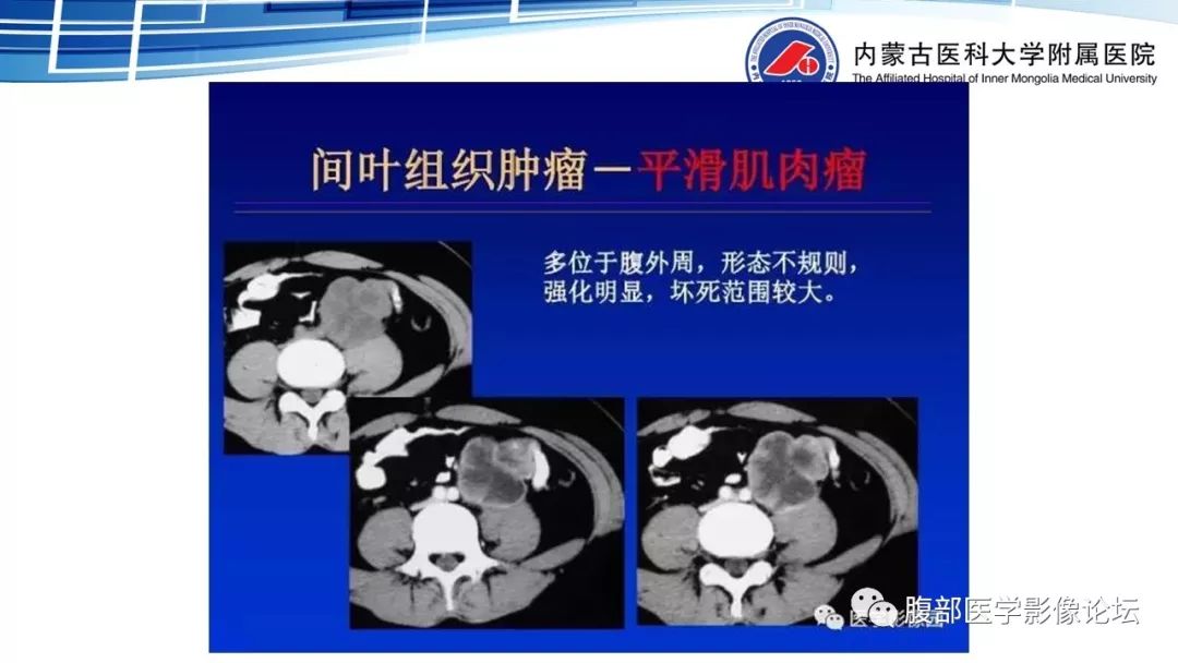 【PPT】腹膜后孤立性纤维瘤的影像
