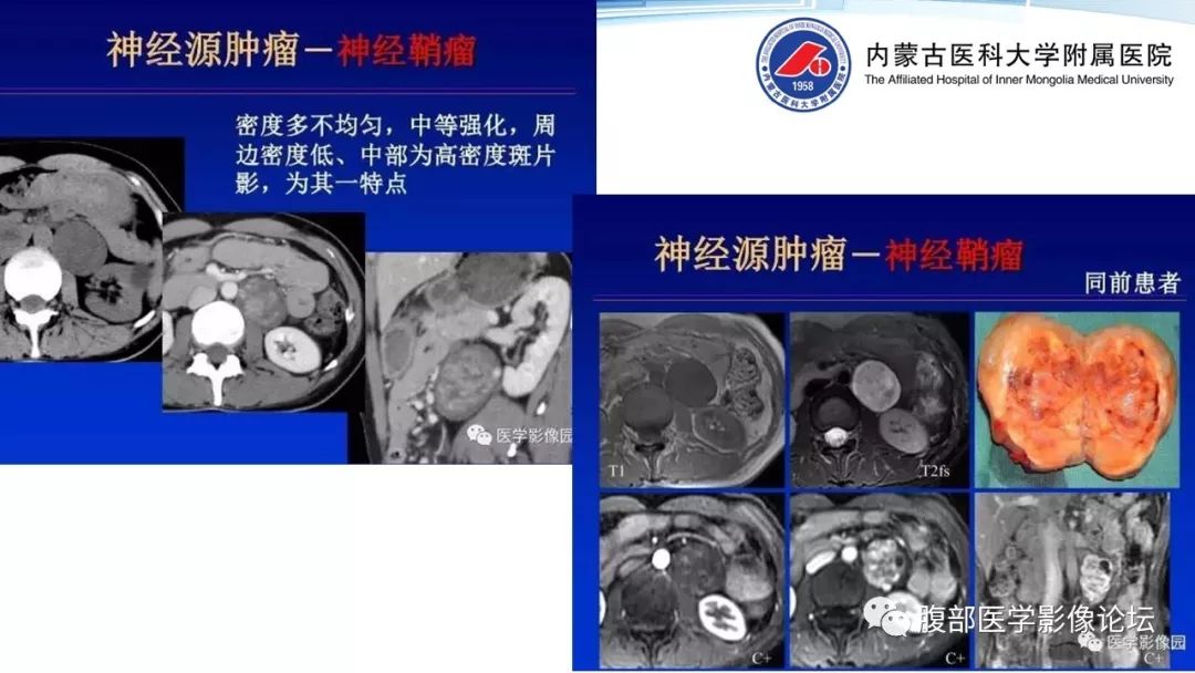 【PPT】腹膜后孤立性纤维瘤的影像