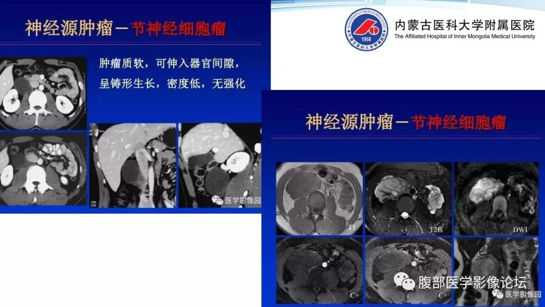 【PPT】腹膜后孤立性纤维瘤的影像