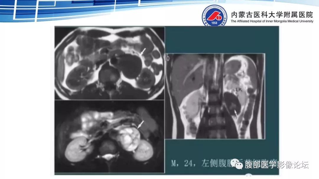 【PPT】腹膜后孤立性纤维瘤的影像
