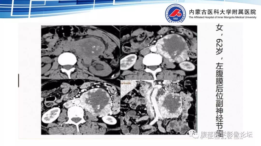 【PPT】腹膜后孤立性纤维瘤的影像