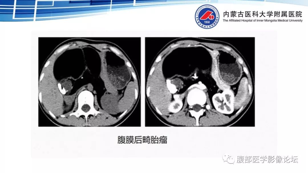 【PPT】腹膜后孤立性纤维瘤的影像