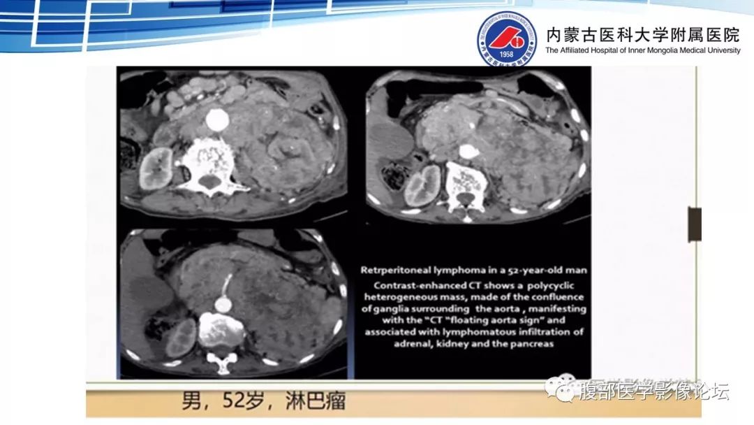 【PPT】腹膜后孤立性纤维瘤的影像