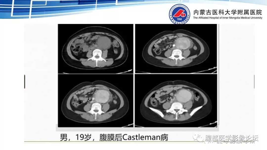 【PPT】腹膜后孤立性纤维瘤的影像