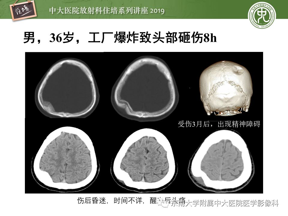 【PPT】成人颅脑损伤影像评估基本原则