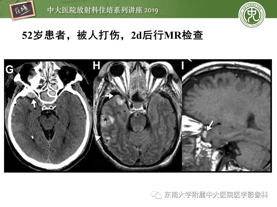 【PPT】成人颅脑损伤影像评估基本原则