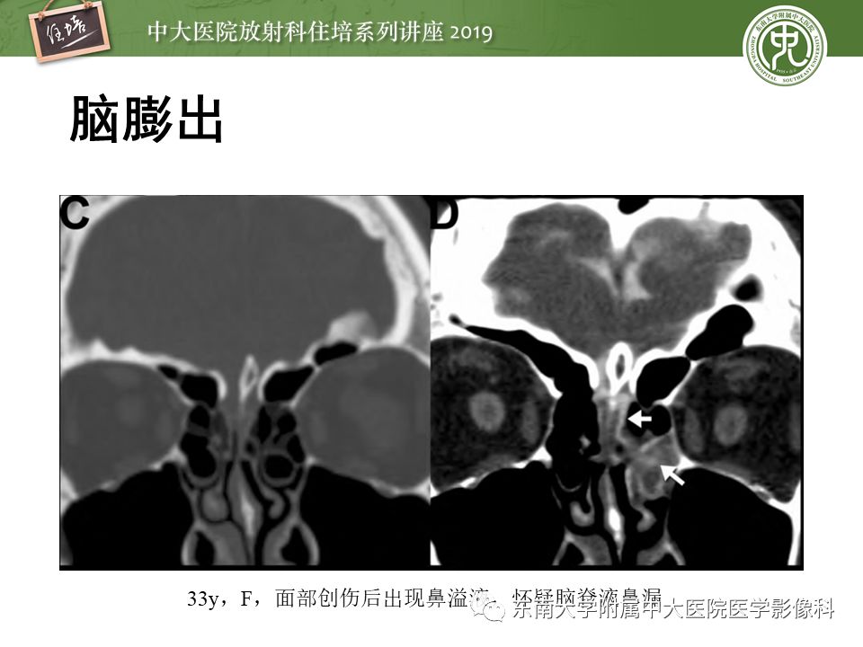 【PPT】成人颅脑损伤影像评估基本原则