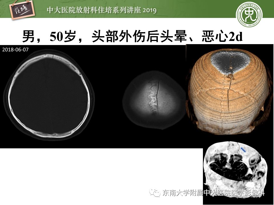 【PPT】成人颅脑损伤影像评估基本原则