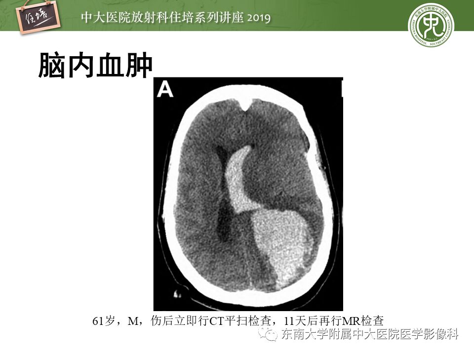 【PPT】成人颅脑损伤影像评估基本原则