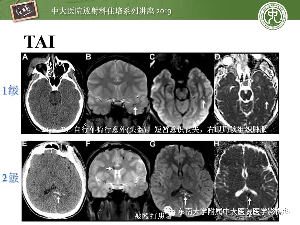 【PPT】成人颅脑损伤影像评估基本原则