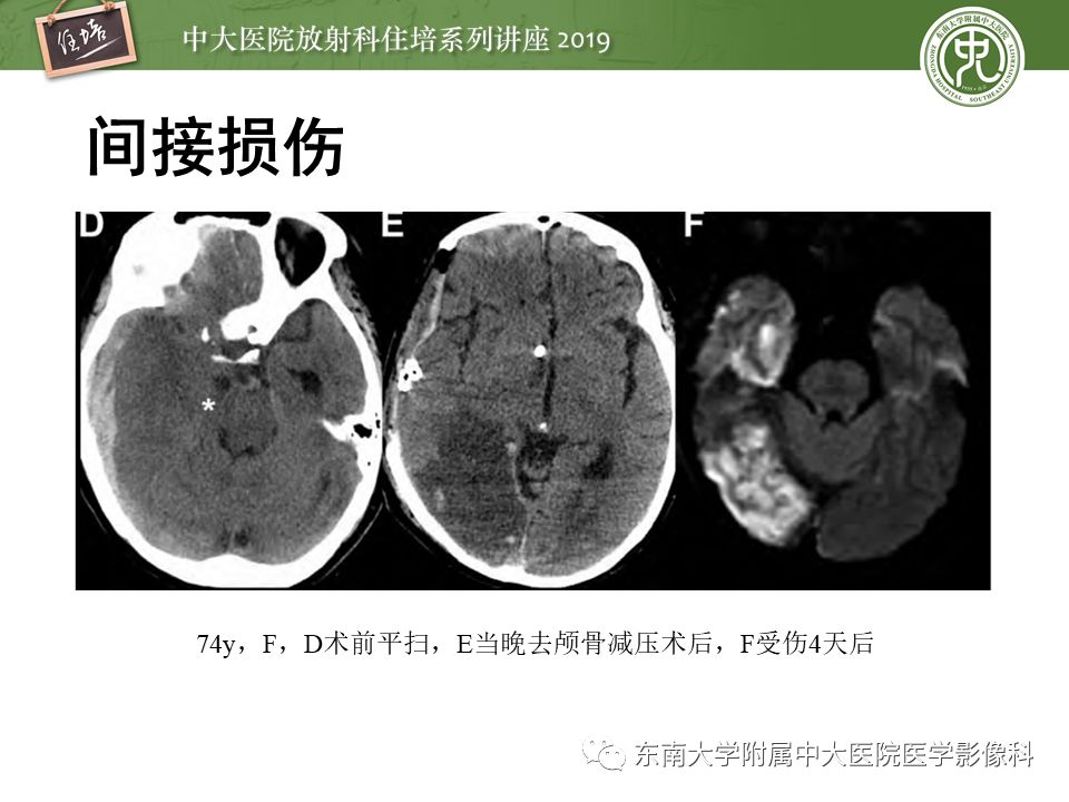 【PPT】成人颅脑损伤影像评估基本原则