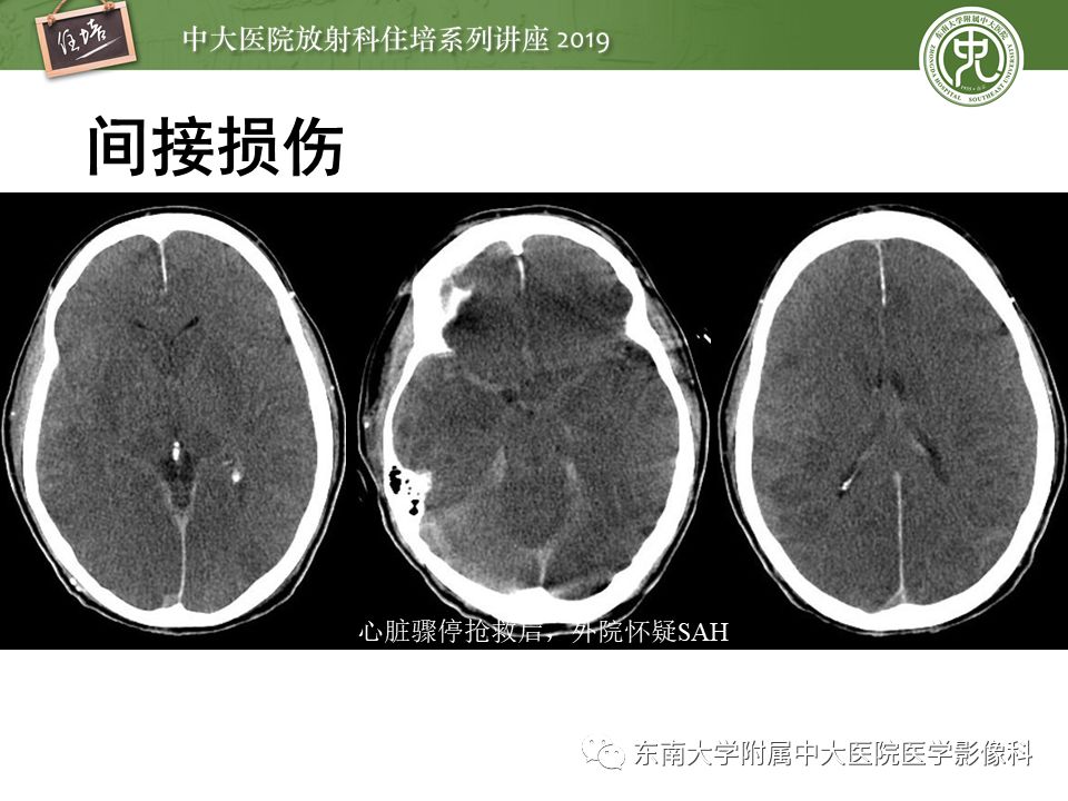 【PPT】成人颅脑损伤影像评估基本原则